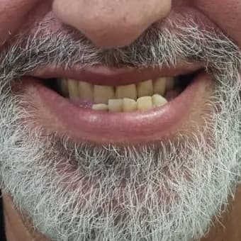 Registro fotográfico intraoral de caso publicado, antes do atendimento