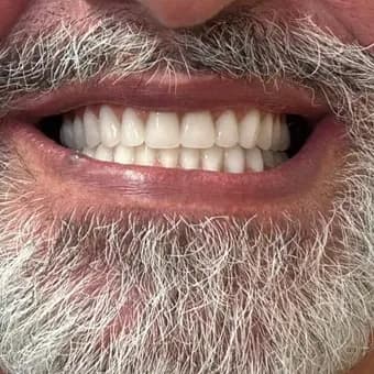 Registro fotográfico intraoral de caso publicado, depois do atendimento