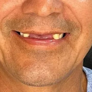 Registro fotográfico intraoral de caso publicado, antes do atendimento