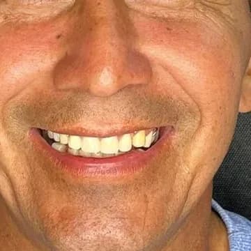 Registro fotográfico intraoral de caso publicado, depois do atendimento