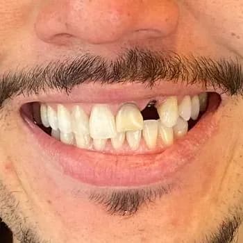 Registro fotográfico intraoral de caso publicado, antes do atendimento