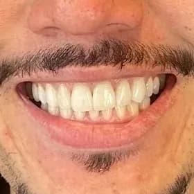 Registro fotográfico intraoral de caso publicado, depois do atendimento