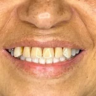 Registro fotográfico intraoral de caso publicado, antes do atendimento