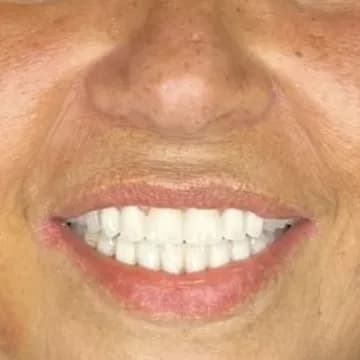 Registro fotográfico intraoral de caso publicado, depois do atendimento