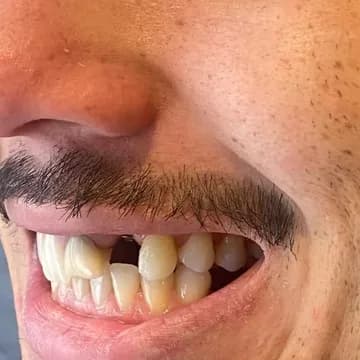 Registro fotográfico intraoral de caso publicado, antes do atendimento
