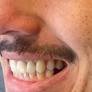 Registro fotográfico intraoral de caso publicado, depois do atendimento
